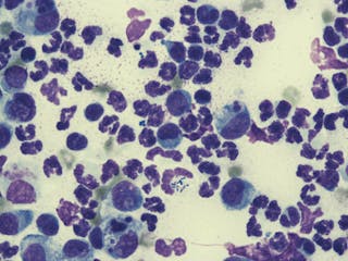 ภาพจากกล้องจุลทรรศน์กำลังขยาย 100 เท่าของการทำ impression smear พบลักษณะ pyogranulomatous inflammation มีเชื้อแบคทีเรียชนิด cocci และ bacilli ในเซลล์เม็ดเลือดขาวสอดคล้องกับการติดเชื้อแบคทีเรีย